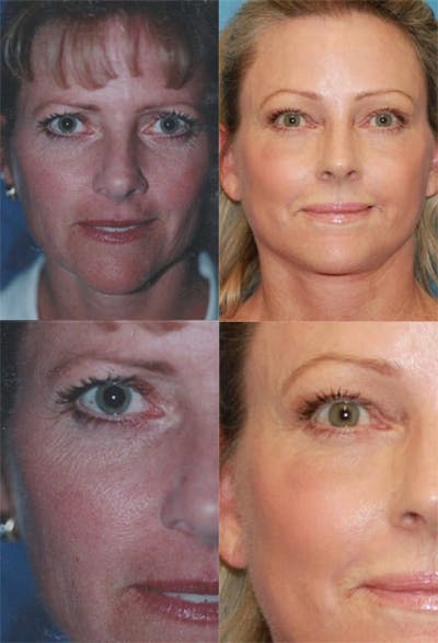 Brow Lift Before & After Gallery - Patient 2848102 - Image 1