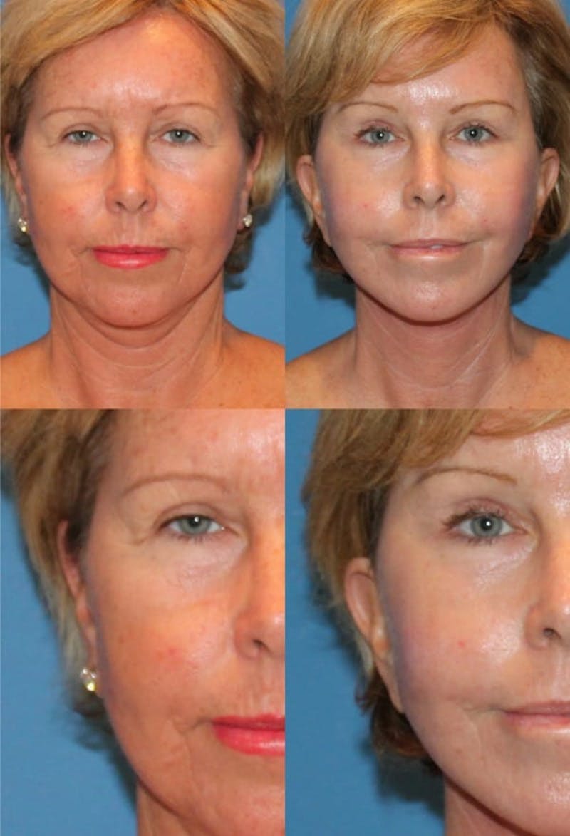 Brow Lift Before & After Gallery - Patient 2848105 - Image 1