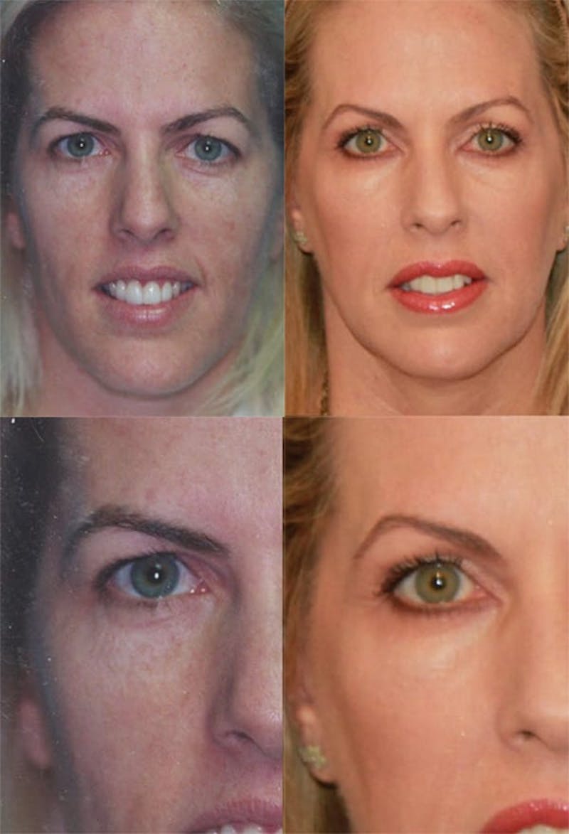 Brow Lift Before & After Gallery - Patient 2848107 - Image 1