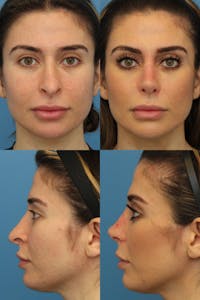 Female Prominent Nostril / Hanging Columella Before & After Gallery - Patient 3176167 - Image 1