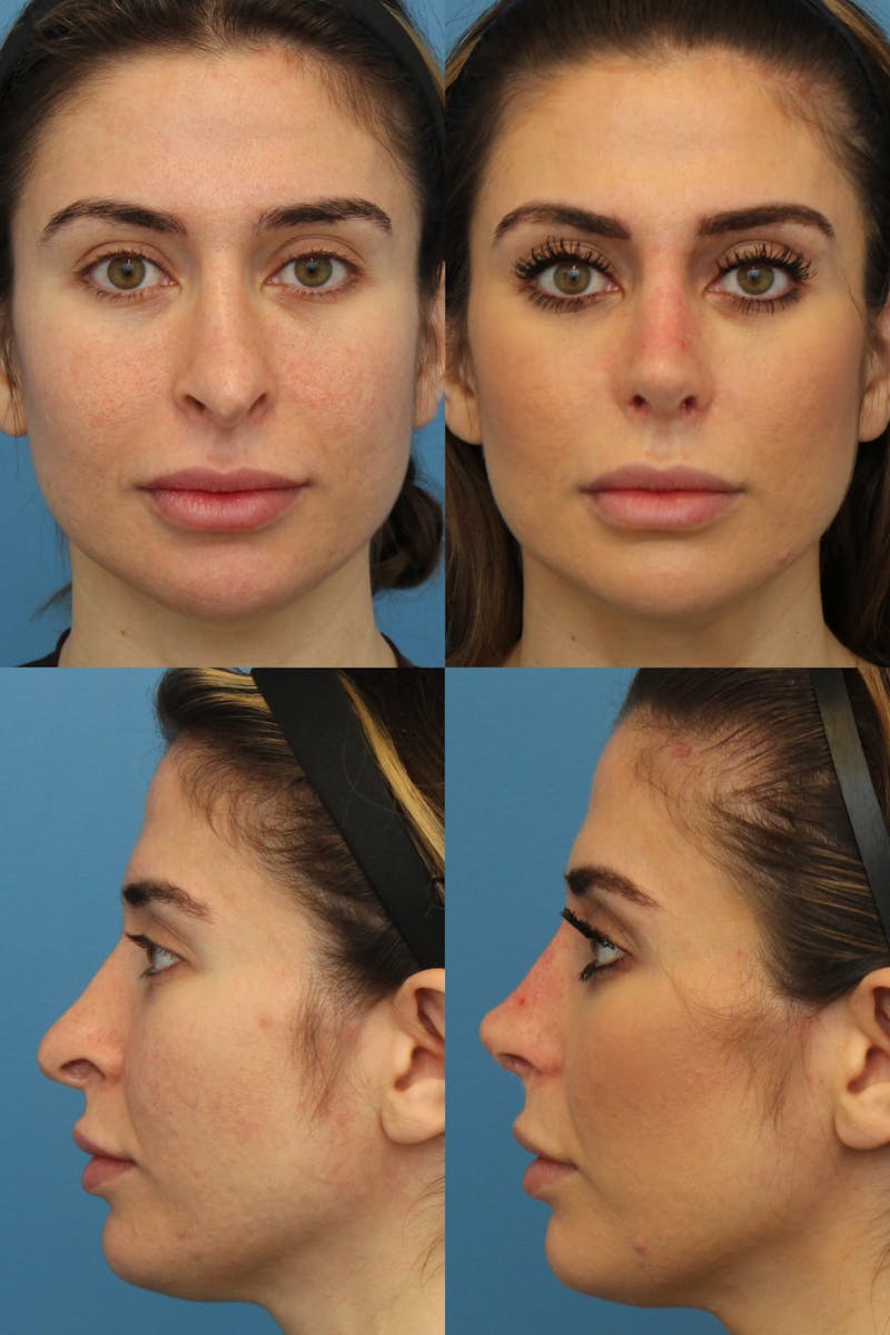 Female Revision Rhinoplasty Before & After Gallery - Patient 3176168 - Image 1