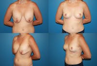 En Bloc Capsulectomy Before & After Gallery - Patient 2162084 - Image 1
