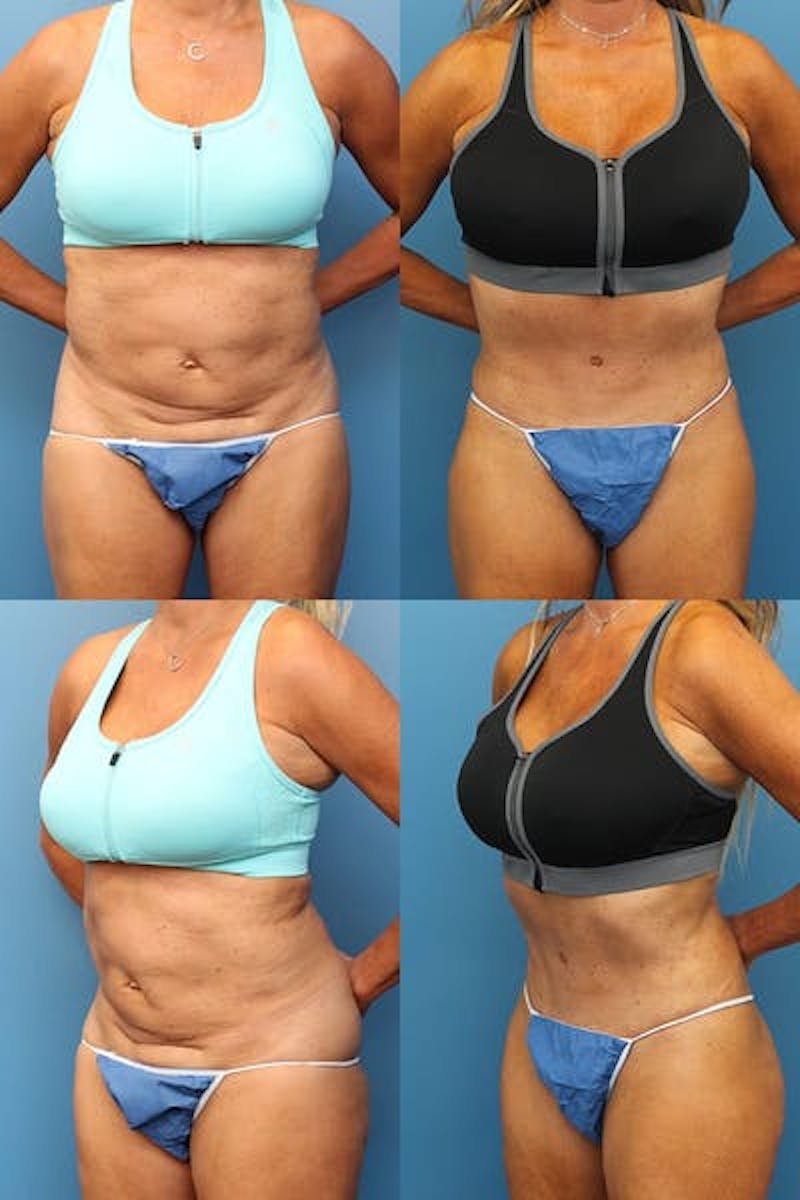 Tummy Tuck Before & After Gallery - Patient 3254354 - Image 1