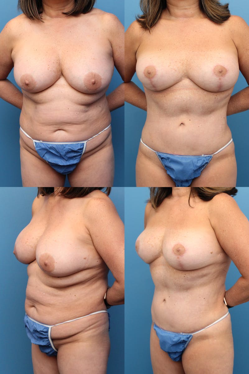 Mommy Makeover Before & After Gallery - Patient 2161935 - Image 1