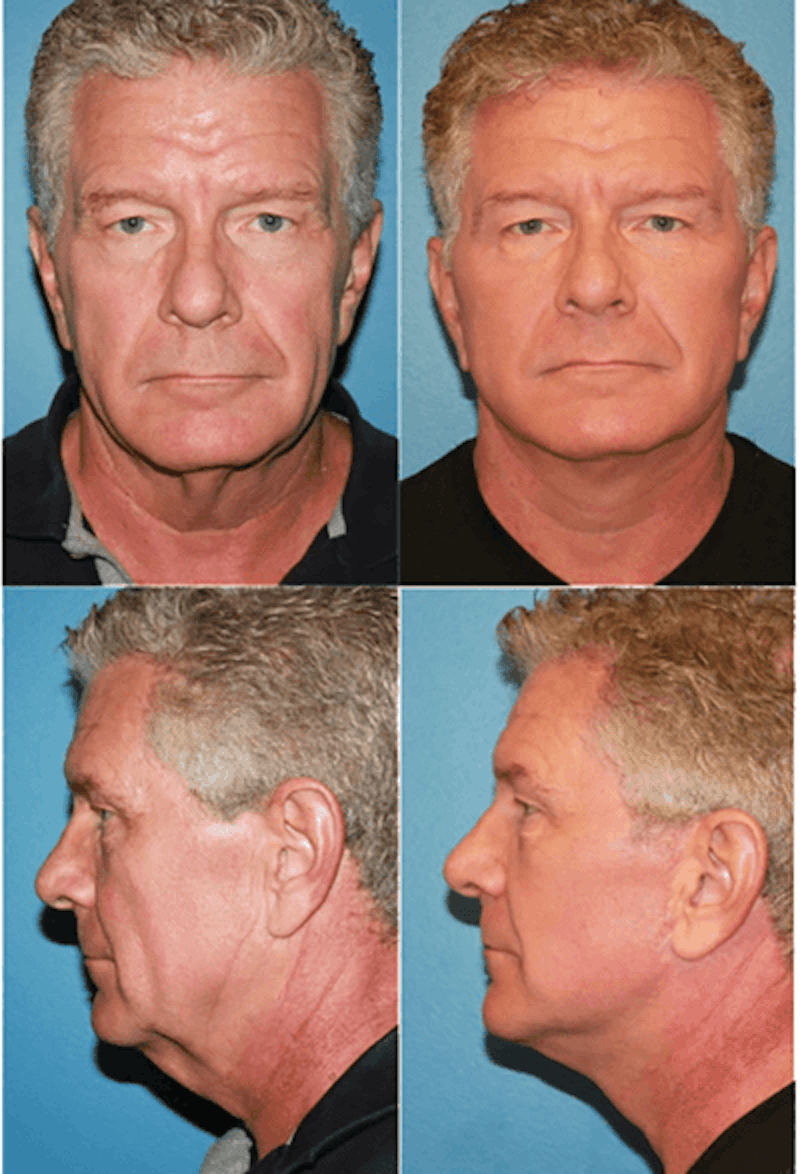 Face Lift Before & After Gallery - Patient 3255815 - Image 1