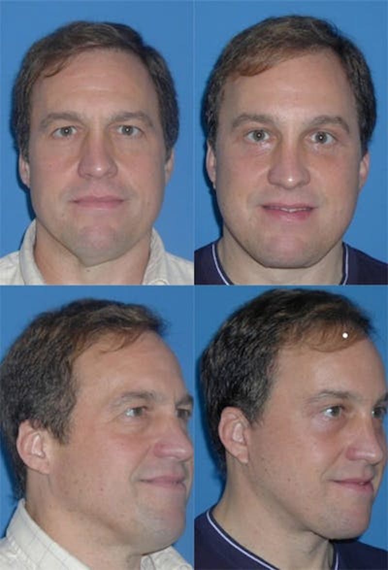 Face Lift Before & After Gallery - Patient 3255816 - Image 1