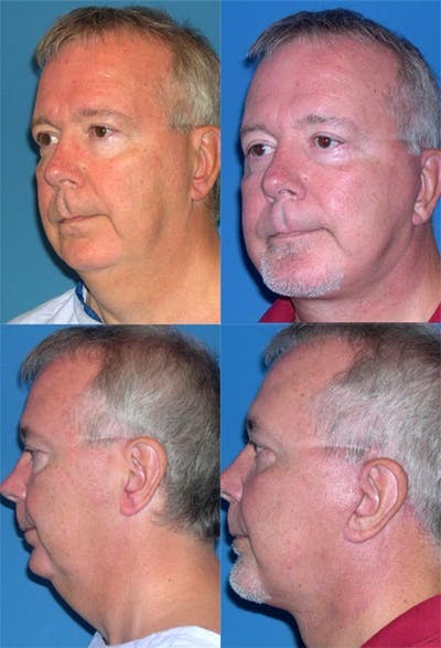 Face Lift Before & After Gallery - Patient 3255817 - Image 1