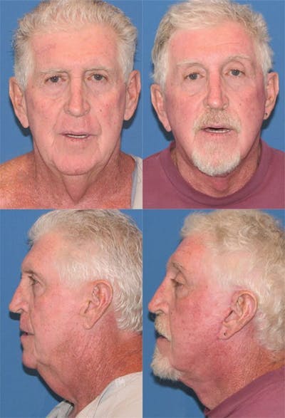 Face Lift Before & After Gallery - Patient 3255818 - Image 1
