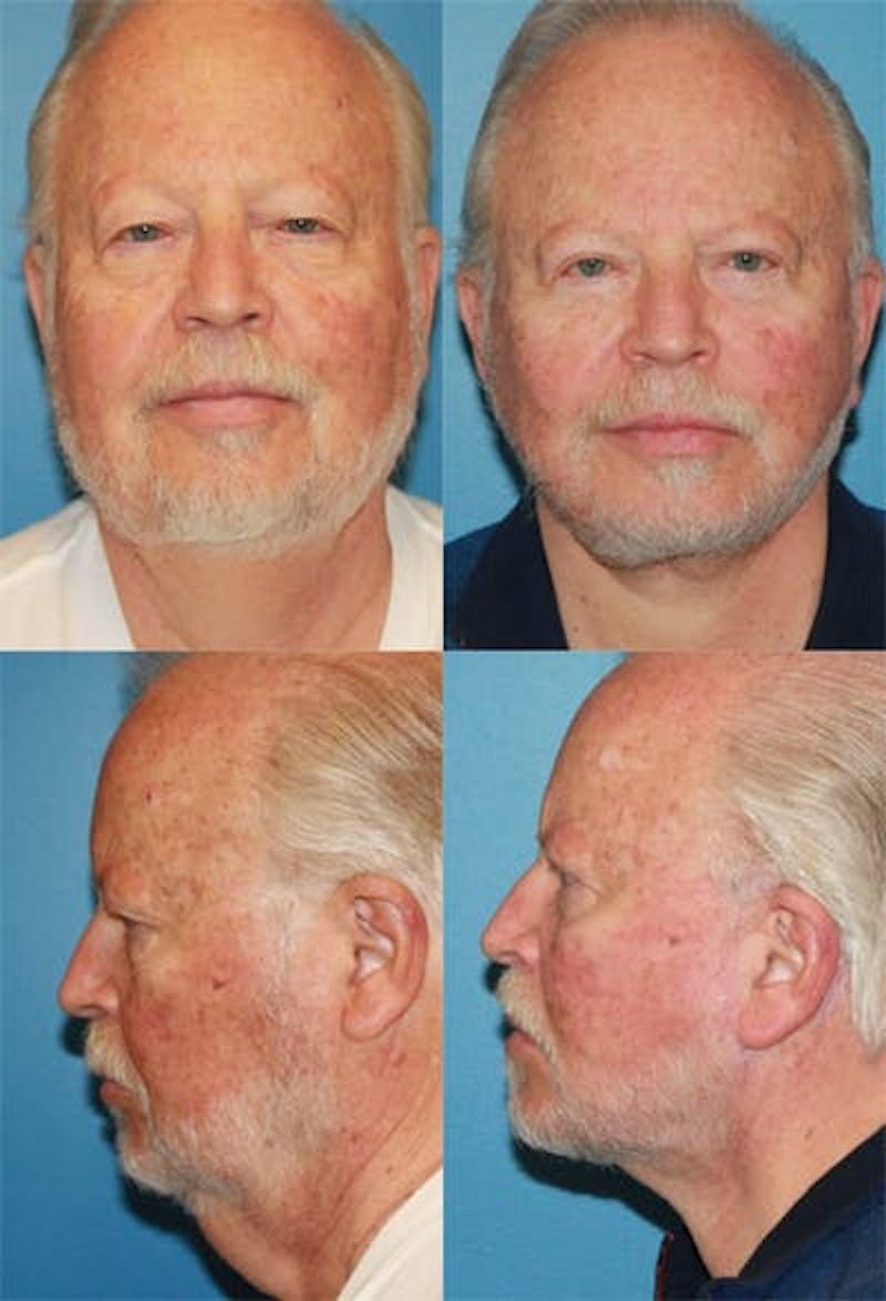 Face Lift Before & After Gallery - Patient 3255819 - Image 1