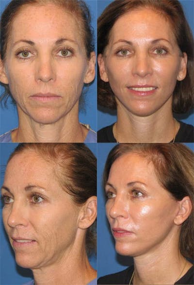 Face Lift Before & After Gallery - Patient 3255821 - Image 1