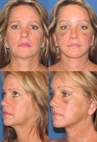 Face Lift Before & After Gallery - Patient 3255822 - Image 1