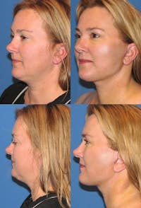 Face Lift Before & After Gallery - Patient 3255824 - Image 1