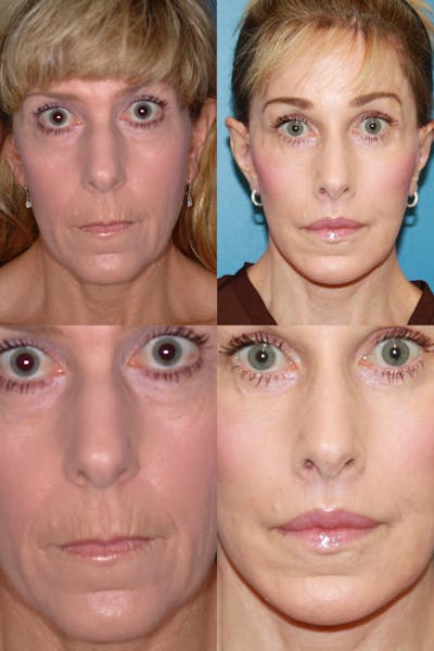 Lip Lift Before & After Gallery - Patient 2158566 - Image 1
