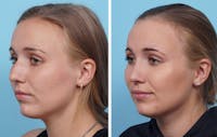 Dr. Balikian's Rhinoplasty Before & After Gallery - Patient 3571989 - Image 1