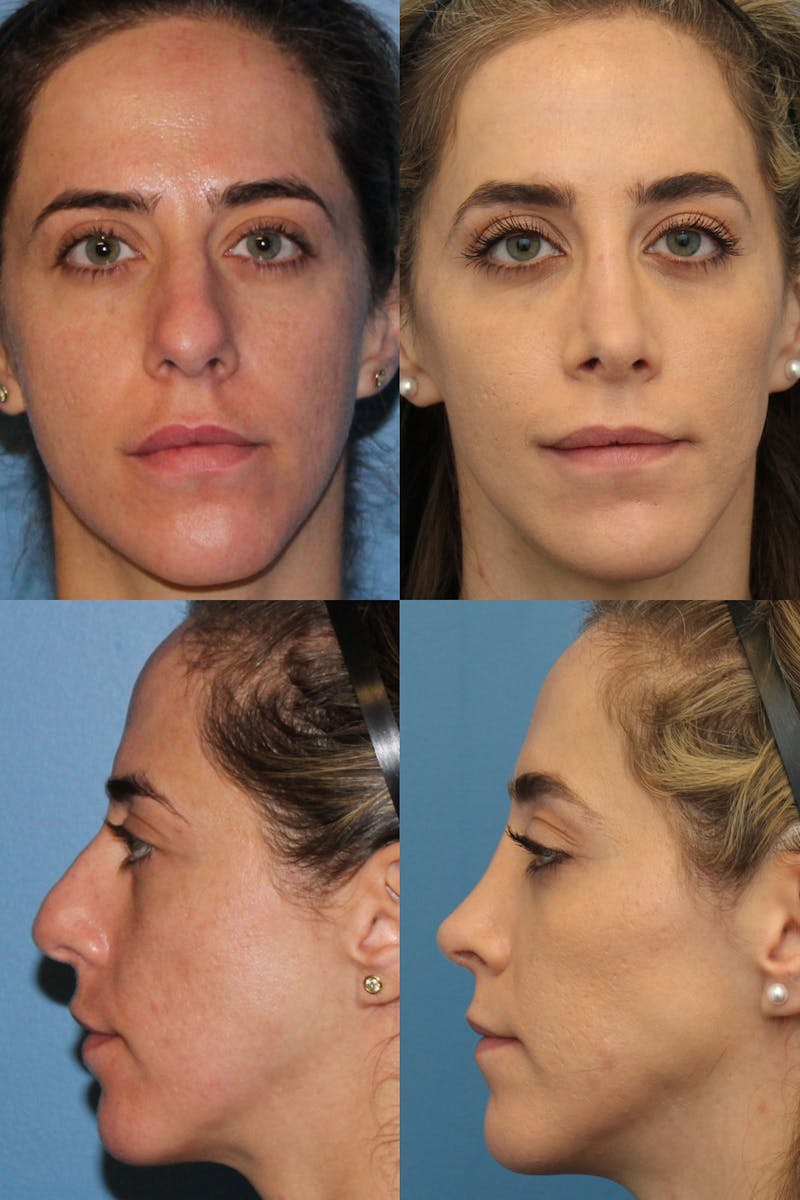 Female Rhinoplasty Before & After Gallery - Patient 3664240 - Image 1