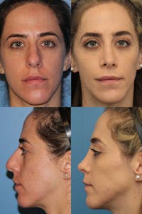 Female Bulbous Tip Before & After Gallery - Patient 3664272 - Image 1