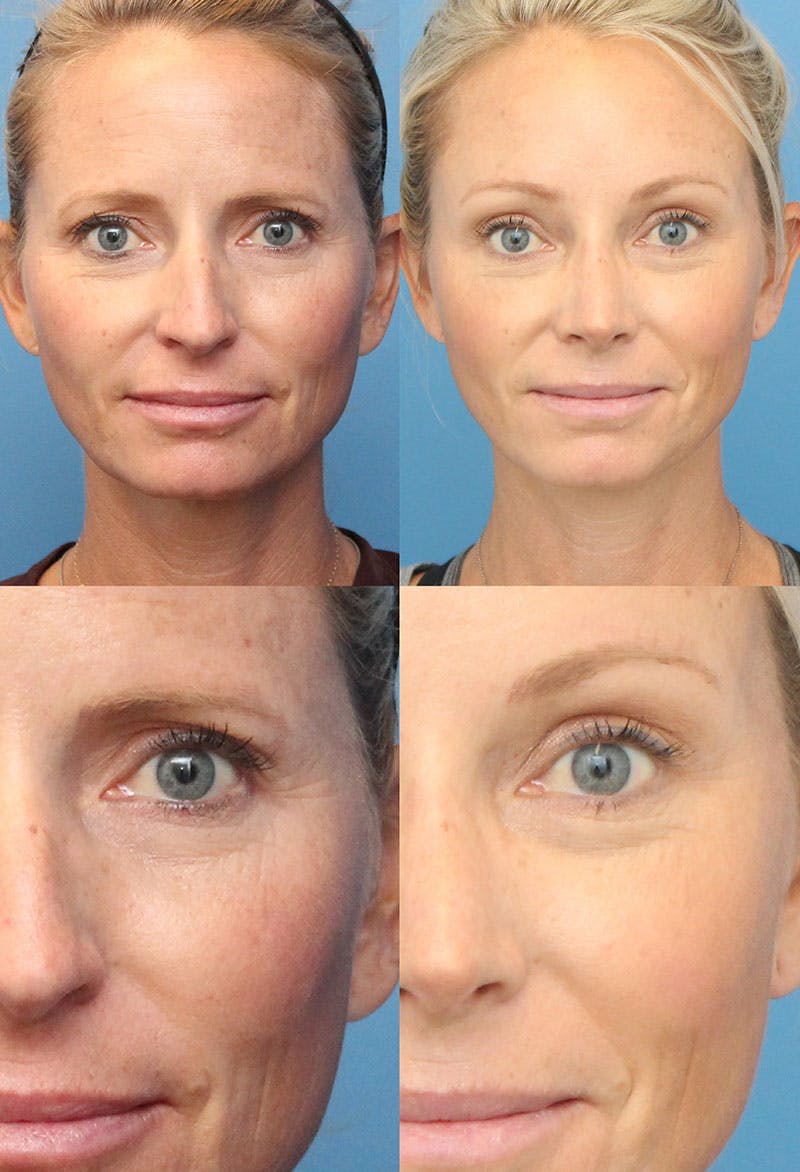 Broer Haarvaten verdrietig Brow Lift Surgery in San Diego - Forehead Lift Before And After Photos