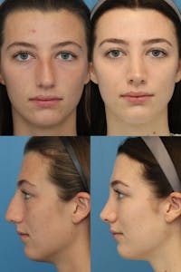Crooked Nose Before & After Gallery - Patient 4586818 - Image 1