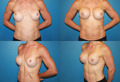 Breast Revision