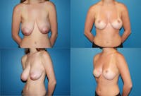 Breast Reduction Before & After Gallery - Patient 2161472 - Image 1