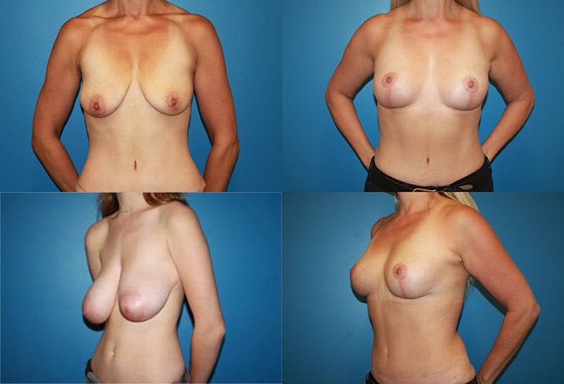 Breast Reduction