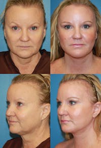 Face Lift Before & After Gallery - Patient 4882276 - Image 1