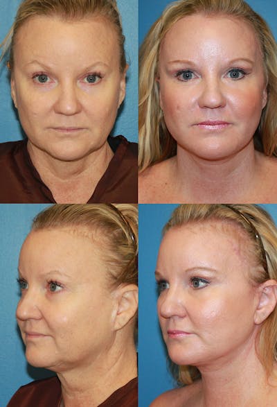 Face Lift Before & After Gallery - Patient 4882276 - Image 1