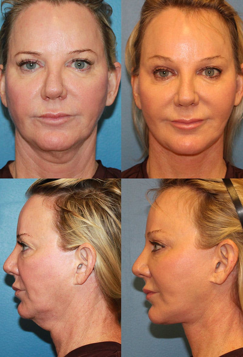 Facelift Before and After  Ranch & Coast Plastic Surgery