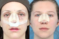 No bruise Rhinoplasty – One day Post-operative Before & After Gallery - Patient 5096348 - Image 1