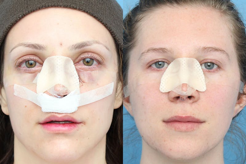 No bruise Rhinoplasty – One day Post-operative Before & After Gallery - Patient 5096348 - Image 1