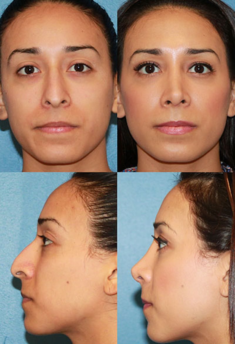 Female Prominent Nostril / Hanging Columella Before & After Gallery - Patient 2388268 - Image 1
