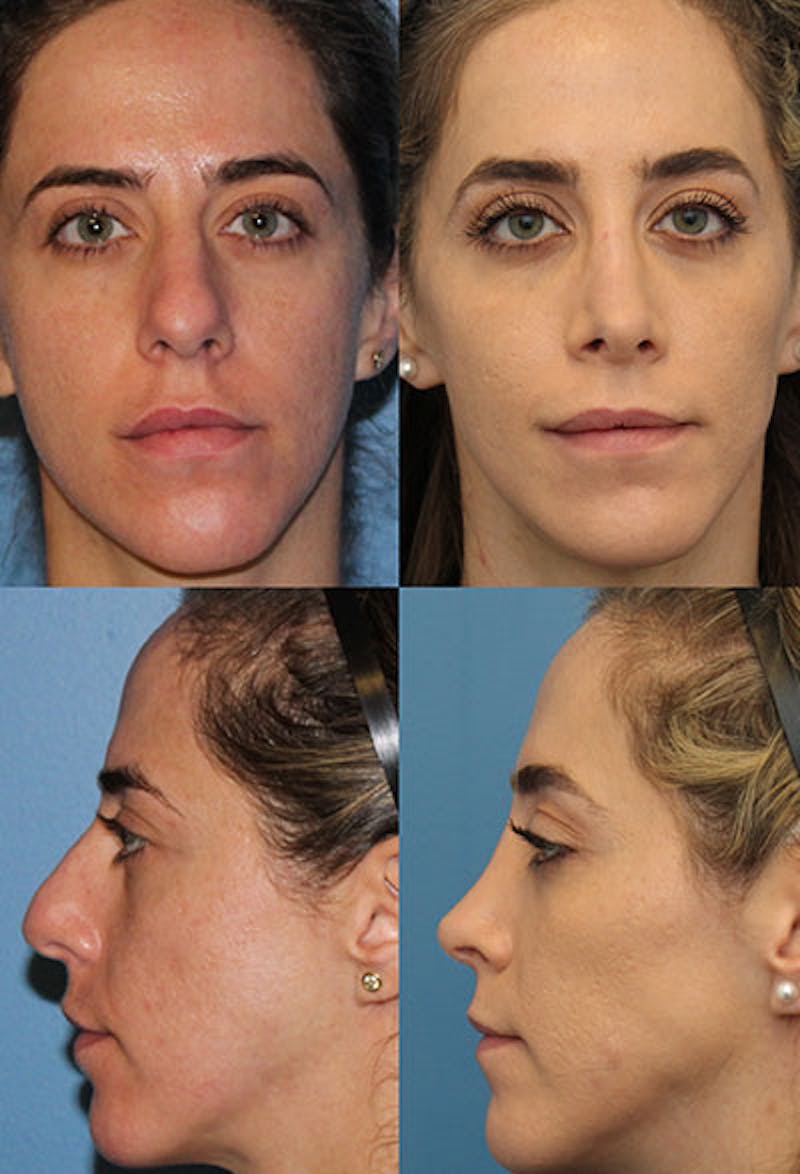Female Drooping Tip Before & After Gallery - Patient 5098240 - Image 1