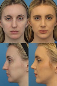 Female Bulbous Tip Before & After Gallery - Patient 5114253 - Image 1