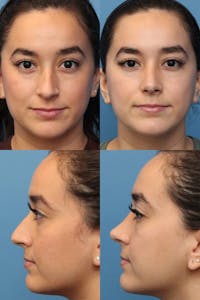 Female Bulbous Tip Before & After Gallery - Patient 5114254 - Image 1