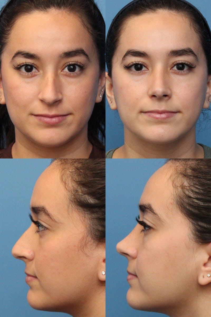 Female Bulbous Tip Before & After Gallery - Patient 5114254 - Image 1