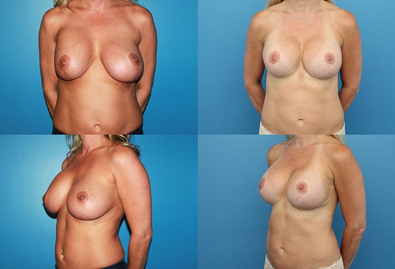 Correction of Long Term Changes Associated with Implants on Top of the Muscle Gallery - Patient 5147443 - Image 1