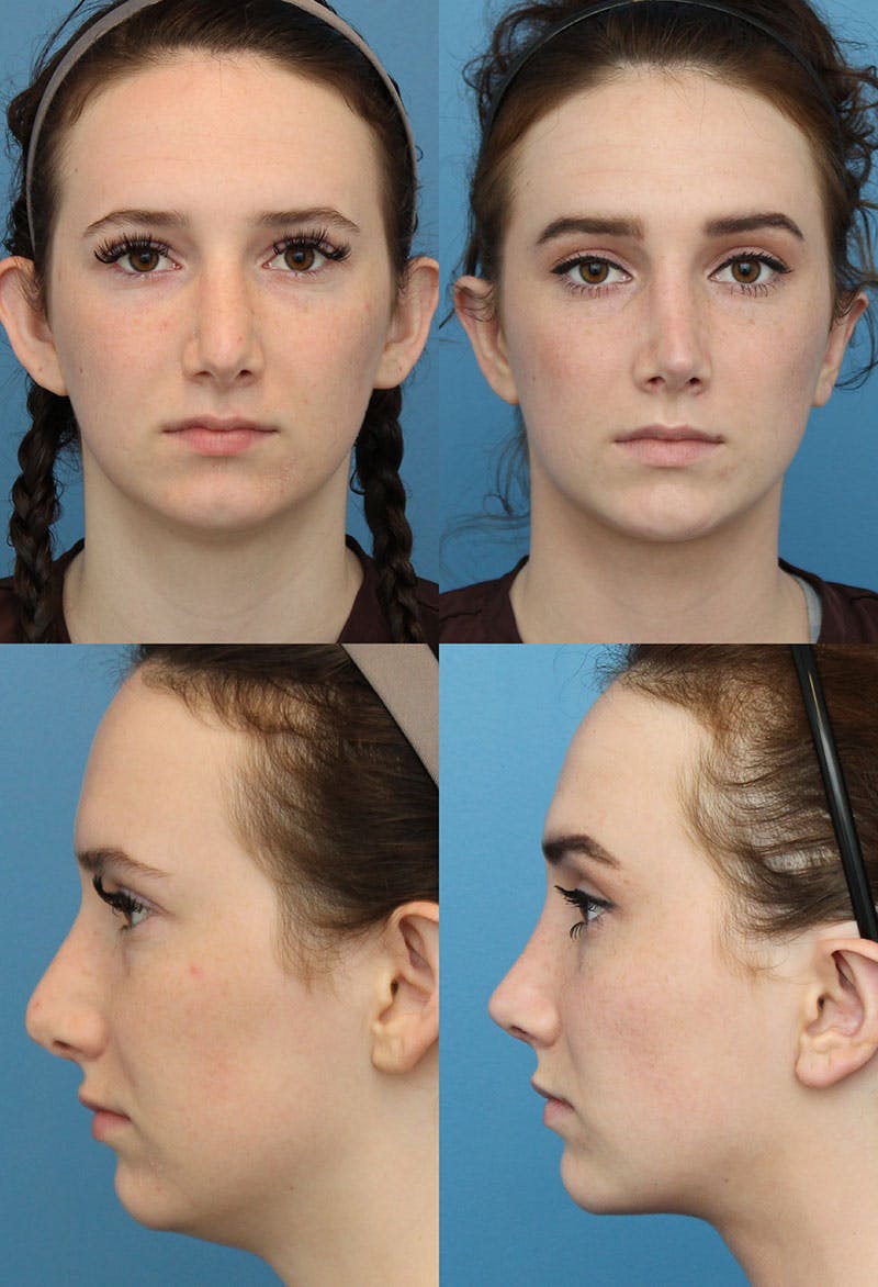 Female Revision Rhinoplasty Before & After Gallery - Patient 5157412 - Image 1