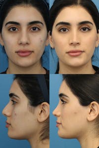 Female Bulbous Tip Before & After Gallery - Patient 5426189 - Image 1