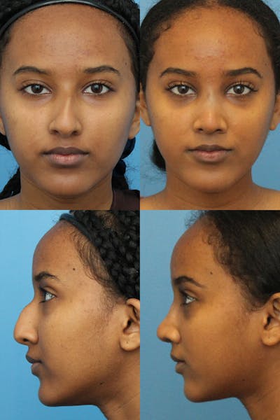 Crooked Nose Before & After Gallery - Patient 5468578 - Image 1
