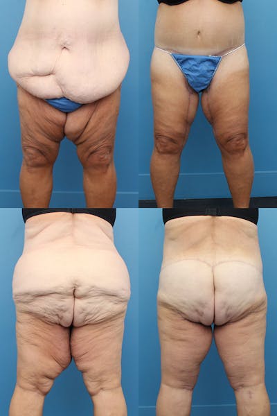 Body Lift / Thigh Lift Before & After Gallery - Patient 5468579 - Image 1