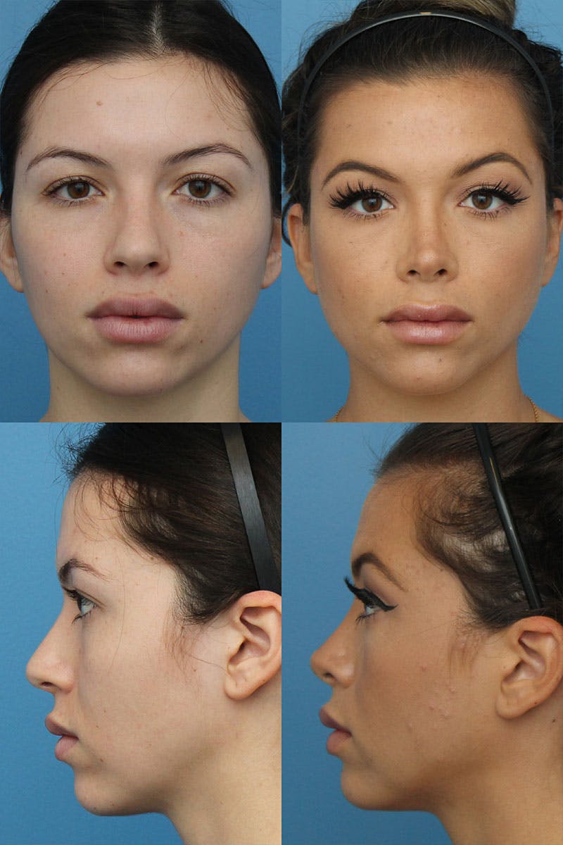 Female Bulbous Tip Before & After Gallery - Patient 5468583 - Image 1