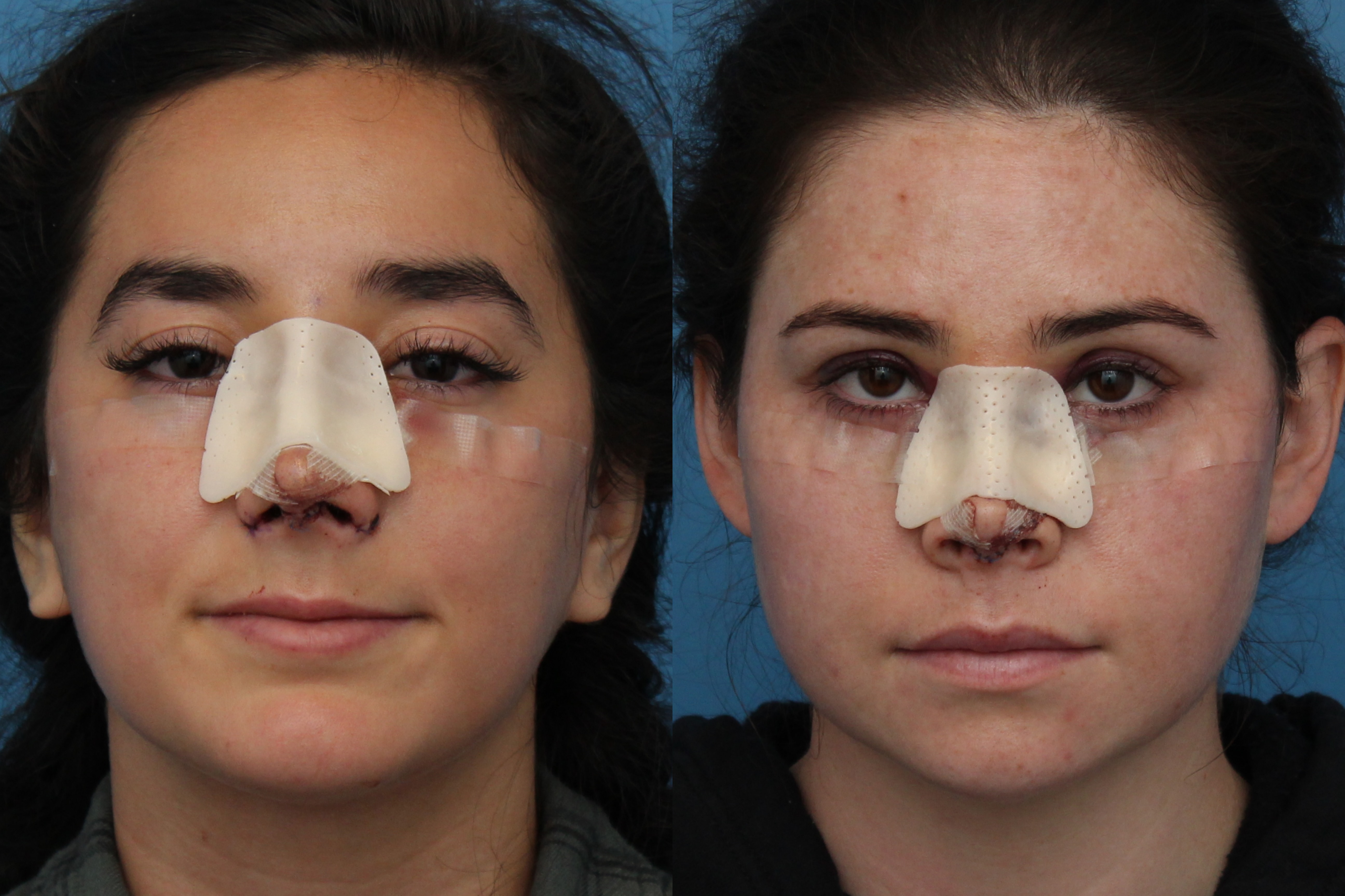 Post Rhinoplasty