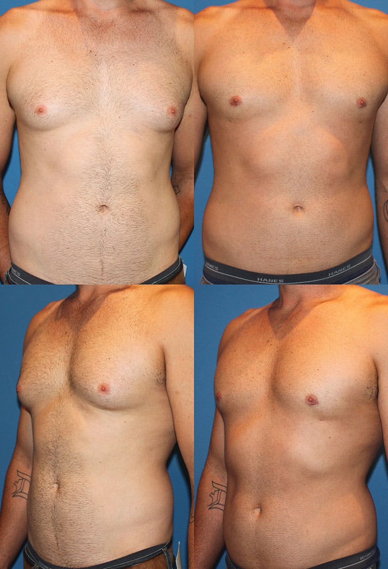 Liposuction Male Before & After Gallery - Patient 2394823 - Image 1