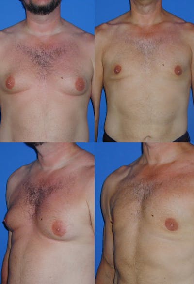 Liposuction Male Gallery - Patient 2394824 - Image 1