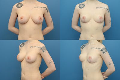 En Bloc Capsulectomy Before & After Gallery - Patient 5928223 - Image 1