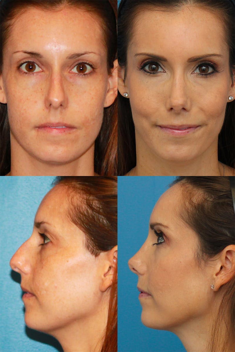 Rhinoplasty Before & After Gallery - Patient 2158409 - Image 1