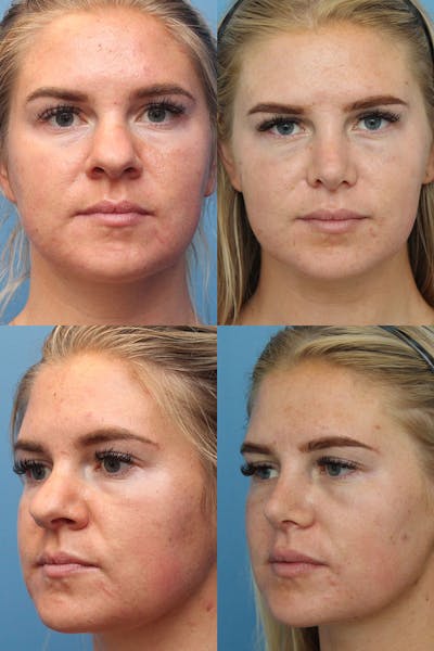 Female Bulbous Tip Before & After Gallery - Patient 6236474 - Image 1