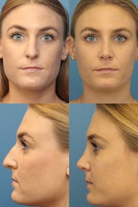 Female Bulbous Tip Before & After Gallery - Patient 6236508 - Image 1