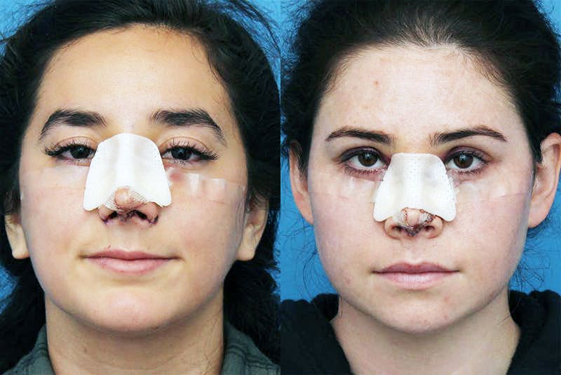No bruise Rhinoplasty – One day Post-operative Before & After Gallery - Patient 5096349 - Image 1