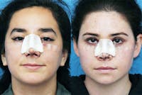 No bruise Rhinoplasty – One day Post-operative Before & After Gallery - Patient 5096349 - Image 1
